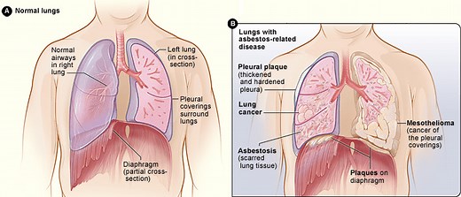 What is Pleural Plaque and Diffuse Pleural thickening?