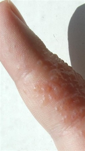 La dishidrosis es una afección que causa pequeñas ampollas con picazón, generalmente en manos y pies 🫱✨. Puede aparecer por estrés, sudoración excesiva, alergias o contacto con ciertos productos. Un diagnóstico adecuado y el tratamiento indicado ayudan a controlar los brotes y mejorar el aspecto de la piel 💧. 👩🏻‍⚕️Dra. Miroslaba Rodríguez | Especialista en Dermatología COFEPRIS 2414102002A00123 📍MIRADERM, Plaza Aleden Puerta #15, Zapopan, Jalisco. ☎️ 33 1724 8969 #dermatologia #dishidrosis 