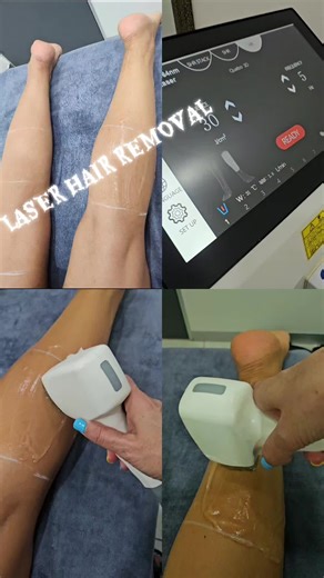 LASER HAIR REMOVAL DONE AT HAVILA BEAUTY HOUSE.....CALL US ON 082 211-8523 #PRIMROSE #HAVILABEAUTYHOUSE #SELFCARE #BEAUTY #NAILART