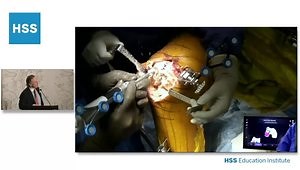 Primary TKR Using Robot Surgical Video