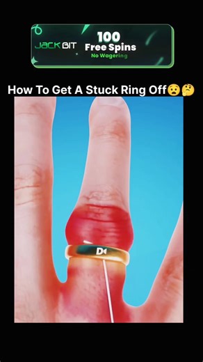 zenti.TV on Instagram: "This reel shares a 22-second instructional clip demonstrating a simple and effective method to remove a stuck ring using dental floss. The technique begins by threading the floss under the ring, then tightly wrapping it around the finger toward the knuckle to compress swelling. As the floss is slowly unwound from beneath the ring, it applies controlled pressure that gradually lifts the ring upward. With each unwind, friction is reduced and the ring advances until it slide