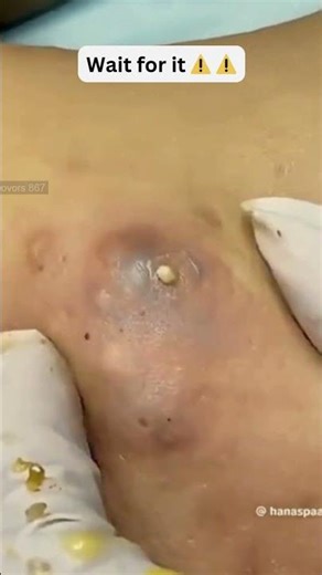 Large Blackheads Extraction Big Cystic Acne Blackheads&Whiteheads Removal Pimple Popping #1059 2026