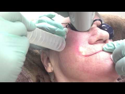 CO2 Laser Skin Resurfacing Around Mouth