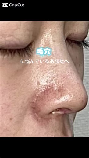 それ、毛穴タイプによって治療違うかも。 黒ずみ？開き？たるみ？クレーター？ 正解の治療、ポンポン出します✋ #毛穴治療 #ピーリング #HIFU #フラクショナルレーザー #イソトレチノイン #美容皮膚科 #肌悩みあるある