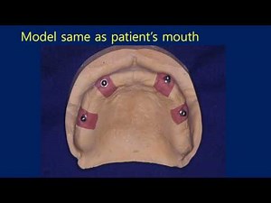 SNAFFIT Overdenture over Maxillary 4 impants