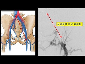 장골정맥 스텐트 삽입술 (세이브 혈관 외과)