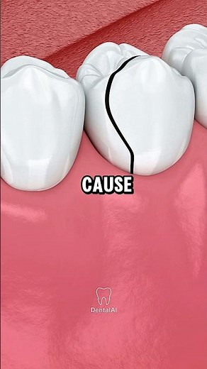 What Happens When You Crack A Tooth 🦷. #dental