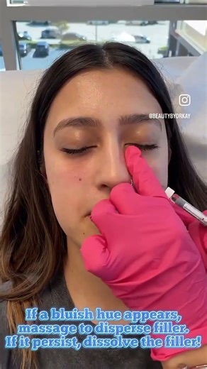 Do you see dark blue circles under the eyes even though you finished a (HA) injection? Here’s why! 👀