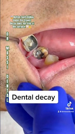 😱 Rotten Tooth Hiding Under the Crown! — decay doesn’t stop at the surface! 🦷⚠️