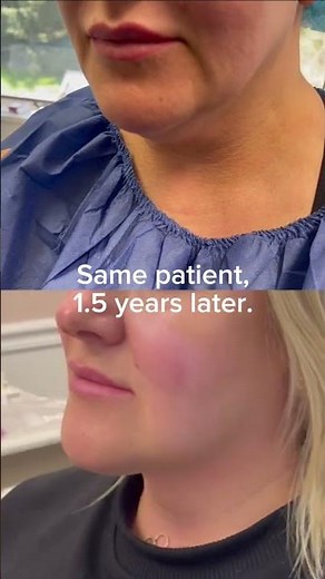 Chin Liposuction and Thermitight Before and After - Dr. Tanveer Janjua