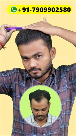 Hair Patch settings Hair transplant Real Game 😜#hairstyle #shorts #haircare #hairtransplant #haircut