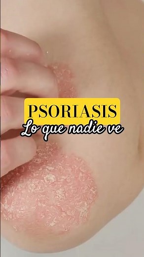 What no one sees about psoriasis