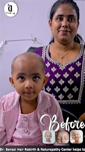 Want to BEAT Alopecia? Dr. Bansal's Cure Revealed in 5 Minutes