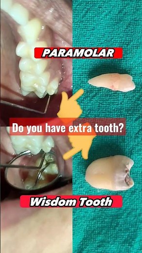 🇳🇵Paramolar-Decayed Wisdom Tooth! Exodontia! Dr. Dentalk Kathmandu Dentist #youtubeshorts #trending