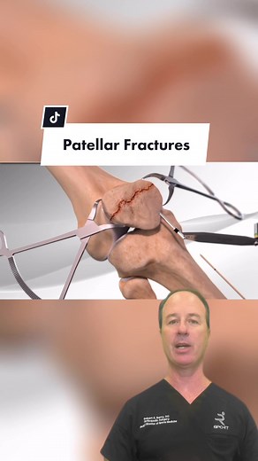 Patella (kneecap) fractures (broken kneecap) are common injuries. About 1% of all broken bones are broken kneecaps. #kneesurgery #kneepain #kneefracture #fyp