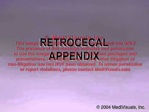 Retrocecal Appendix