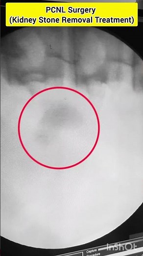 PCNL Surgery, Kidney Stone Removal Treatment by Dr Sandeep Malik Percutaneous nephrolithotomy