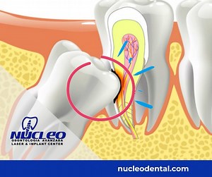 When an impacted #wisdom #tooth becomes infected, damages other #teeth, or causes other #dental problems, you may experience some of these signs or symptoms: Red or swollen #gums. Sensitive or bleeding gums. Jaw pain. . Phone: 915 308 0101 nucleodental.com . #NucleoDental #ElPasoTx🇺🇸 #CiudadJuarez🇲🇽 #NewMexico #dentalclinicnearme #oralcare #oralhealth #dentaltourism #dentaltourismmexico #dentalimplantsmexico #dentalimplantsjuarez #bestdentalserviceintown✌️🦷 #cosmeticdentistry #dentalservice