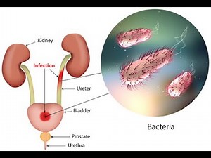 Uropathogenic Escherichia coli (E Coli) ; Definition, Symptoms, Infections, Treatment