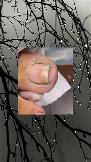Effective Solutions for Ingrown Toenail Removal