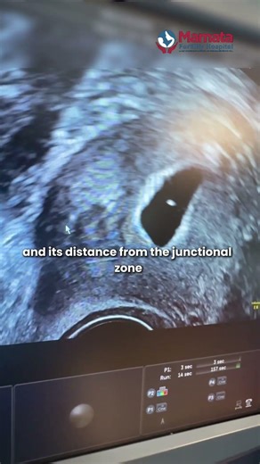 Sonohysterography (SHG) Explained in Real Case | Mamata Fertility Hospital: Hyderabad