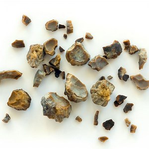 Kidney Stones - Associated Urological Specialists