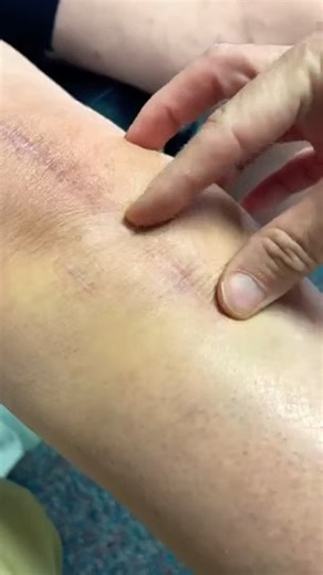 Scar tissue mobilization for the incision after a total knee replacement. | Total Therapy Solutions: Physical Therapy