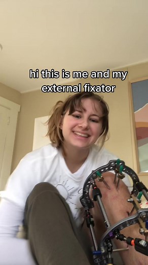 Orthopedic Surgery Recovery: Removing External Fixator from Legs