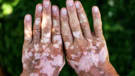 The body changes color as blood settles through livor mortis