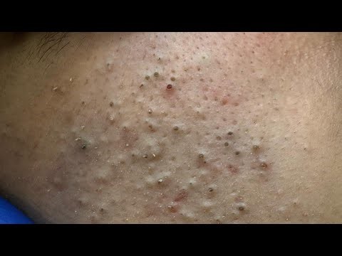 Soko Korean Skincare Routine (For Acne-Scarring, Oily Skin)