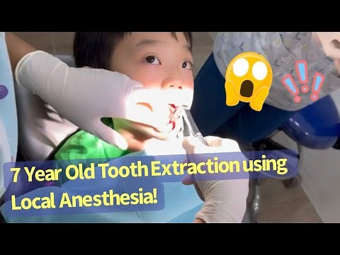 7 Year Old Baby Tooth Extraction With Local Anesthesia! 1st Adult Tooth | Kids Dental | Kids Dentist