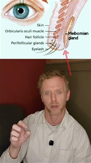 This Eyelash Was Stuck in the Oil Gland of the Eyelid