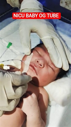 NICU baby OG Tube Insertion|Newborn baby#nicu #baby#neonatology #doctor #pediatrics #neonatologists