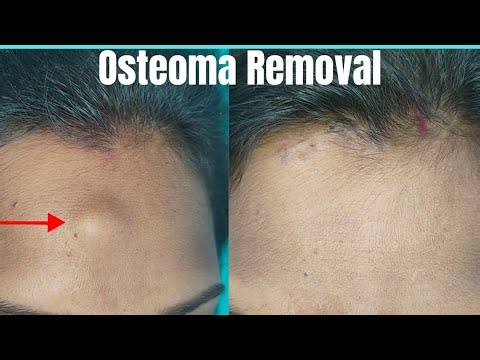 Scarless Osteoma Removal surgery| Osteoma Removal surgery in Ranchi| Best Osteoma Removal #osteoma