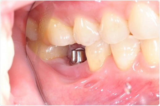History of Dental Implants