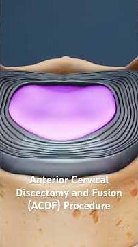 Anterior Cervical Discectomy and Fusion (ACDF) Procedure