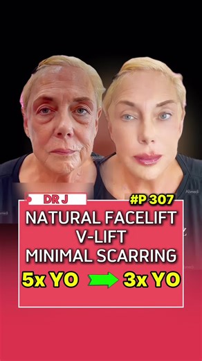 Structured Facial Rejuvenation for Natural Contours