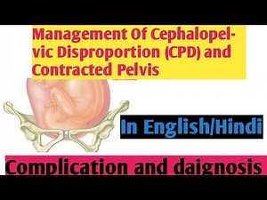 Management Of Cephalopelvic Disproportion (CPD) & Contracted Pelvis II Nightingale Nursing Nursing