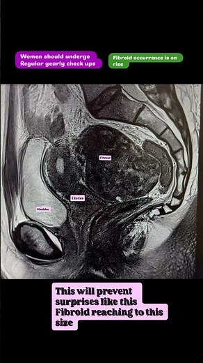 Must-See MRI of a Large Uterine Fibroid | Radiology Case Study #womenshealth #shorts