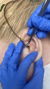 Doctor discovers branch inside woman's ear 🎬This original video was produced by Network Media and MC Has Fun. | Las Vegas Actor Showcase