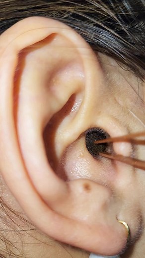 #foryou #earwax #earwaxremoval #earwaxcleaning #blackhead #pimple #