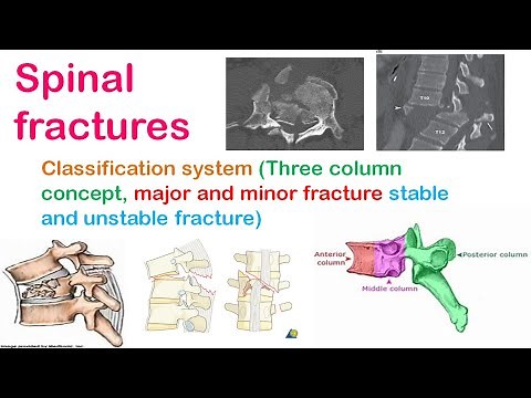 Spinal fracture classification system: Three column concept, Major-minor, Stable-unstable fracture.