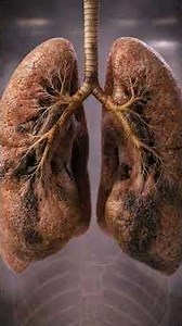 How smoking damages your lungs! #lungs