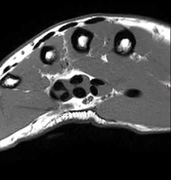 Palmar Fibromatosis (Dupuytren's Disease)