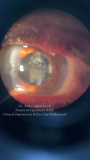 Cloudy vision after cataract surgery? This is Posterior Capsule Opacification (PCO) under slit lamp. Treatment: YAG Laser — quick, painless, and effective. 👁️✨ #optometrist #pakpattan #EyeHealth #PCO #slitlampexam