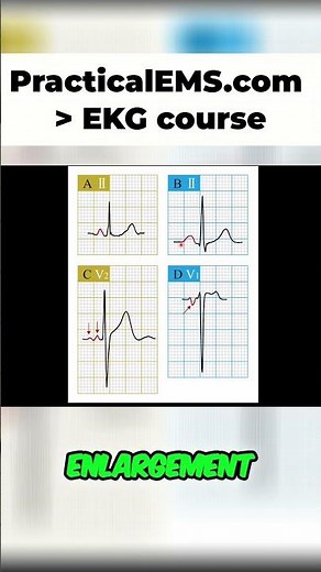 Atrial Enlargement Explained: Understanding P Wave Changes