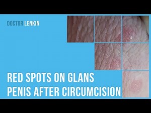 😕 Red spots on glans penis after circumcision
