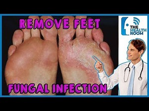 How to REMOVE FUNGAL INFECTION FROM FEET! 5 Natural Ways (2019)