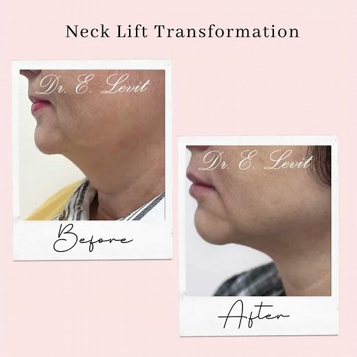 Neck Lift Transformation