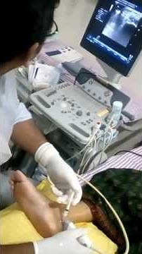 USG guided injection at Retrocalcaneal Bursa